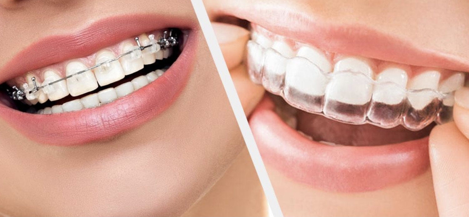 orthodontic treatment